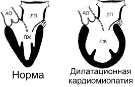 Дилатационная кардиомиопатия