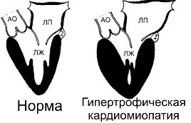 Гипертрофическая кардиомиопатия