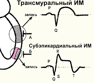 Крупноочаговые ИМ