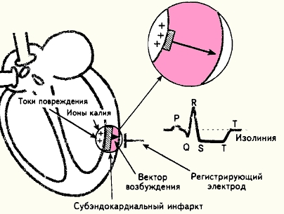 Субэндокардиальный ИМ