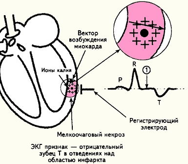 Интрамуральный ИМ