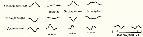 Наиболее распространенные варианты зубца Р