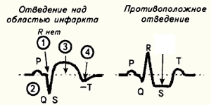 ЭКГ-признаки инфаркта миокарда