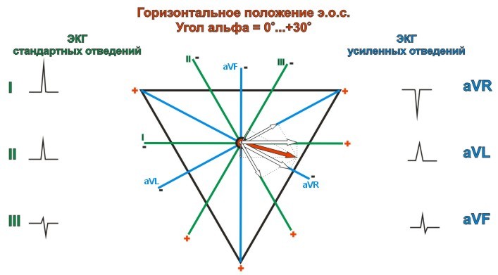 Горизонтальное положение электрической оси сердца