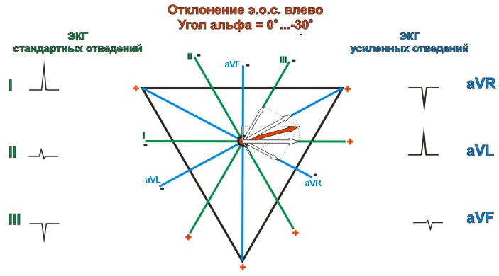 Отклонение электрической оси сердца влево