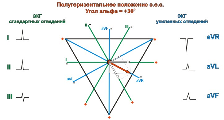 Полугоризонтальное положение электрической оси сердца