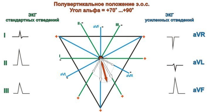 Полувертикальное положение электрической оси сердца