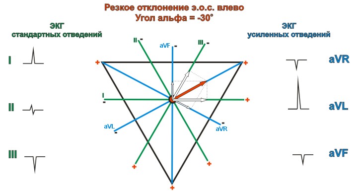 Резкое отклонение электрической оси сердца влево