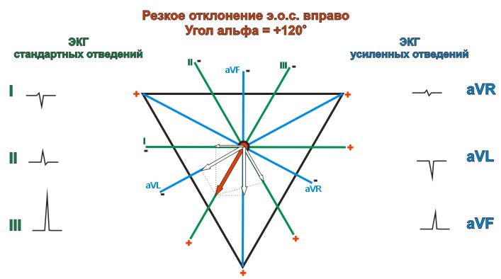 Резкое отклонение электрической оси сердца вправо